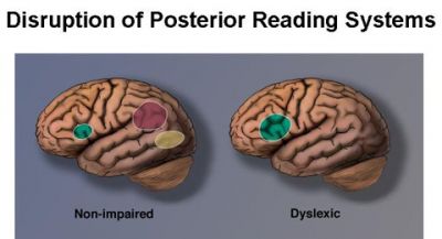 Dyslexia And The Brain